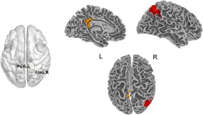 Acupuncture Treatment Decreased Temporal Variability of Dynamic Functional Connectivity in Chronic Tinnitus
